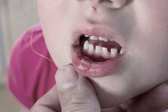 Zahnunfall Traumatologie - Zahnunfall heisst nicht gleich Zahnverlust