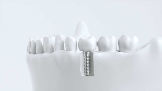 Zahnarztpraxis Maythem Al Fatousi - Implantologie
